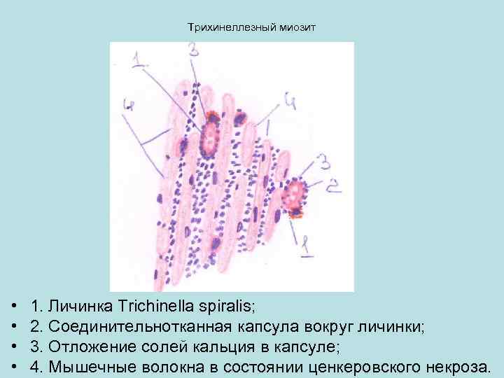 Трихинеллезный миозит • • 1. Личинка Trichinella spiralis; 2. Соединительнотканная капсула вокруг личинки; 3.