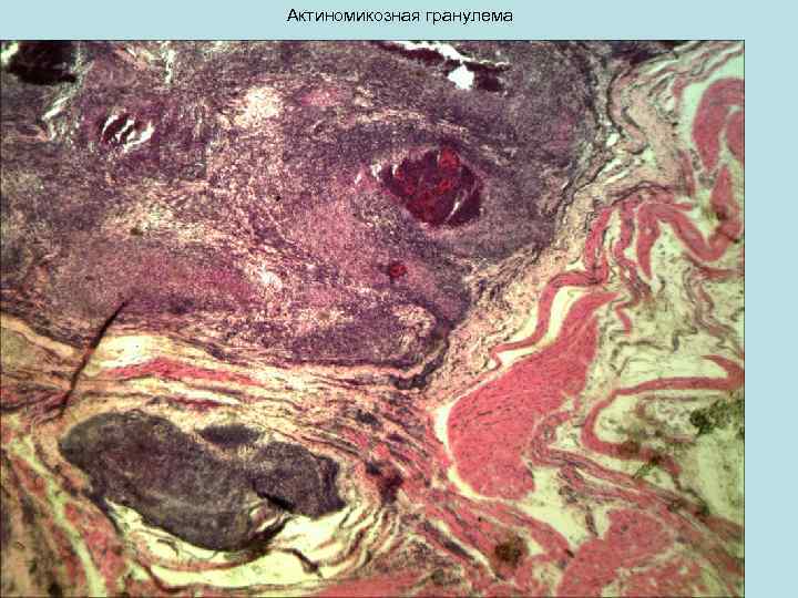 Актиномикозная гранулема 