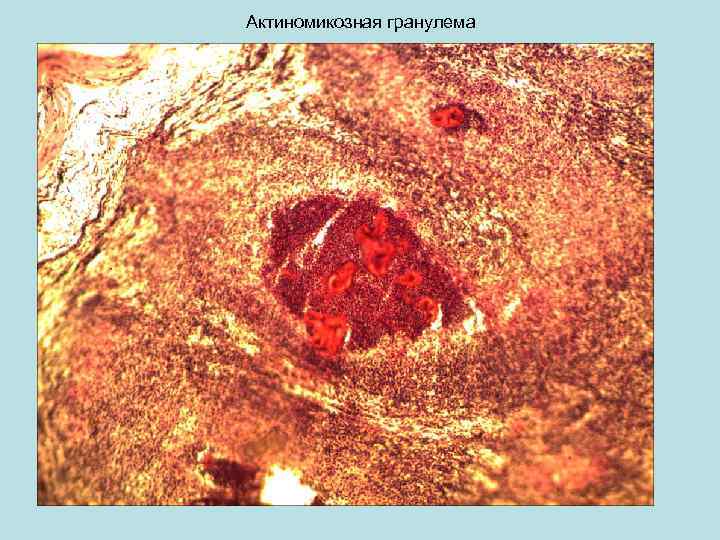 Актиномикозная гранулема 