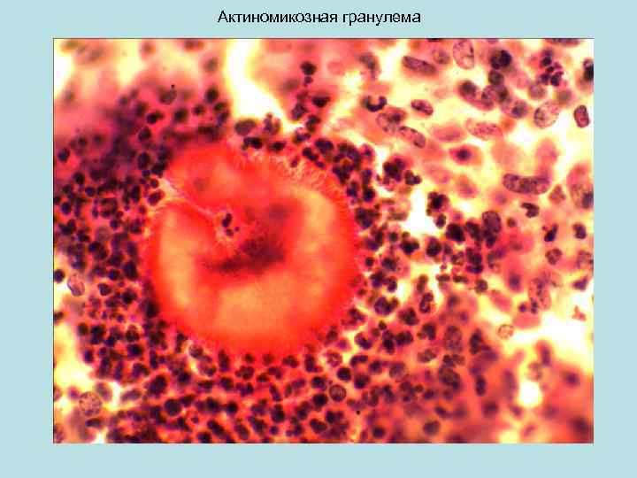Актиномикозная гранулема 