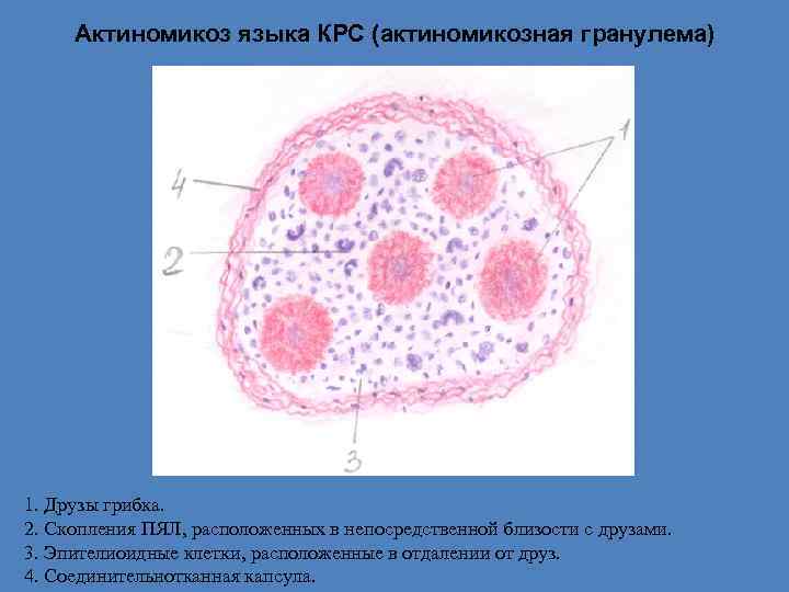 Актиномикоз языка КРС (актиномикозная гранулема) 1. Друзы грибка. 2. Скопления ПЯЛ, расположенных в непосредственной