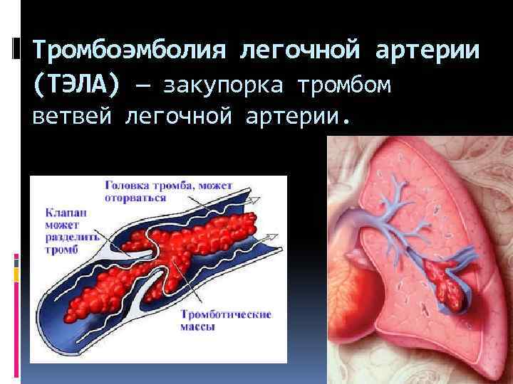 Тромбоэмболия легочной артерии (ТЭЛА) — закупорка тромбом ветвей легочной артерии. 