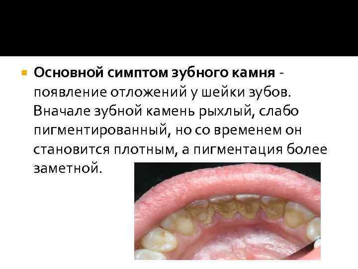  Основной симптом зубного камня - появление отложений у шейки зубов. Вначале зубной камень