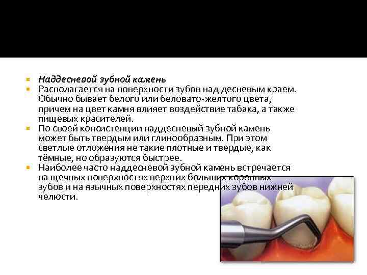 Наддесневой зубной камень Располагается на поверхности зубов над десневым краем. Обычно бывает белого или