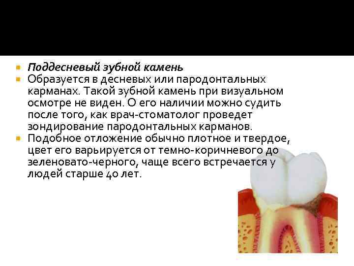Поддесневый зубной камень Образуется в десневых или пародонтальных карманах. Такой зубной камень при визуальном