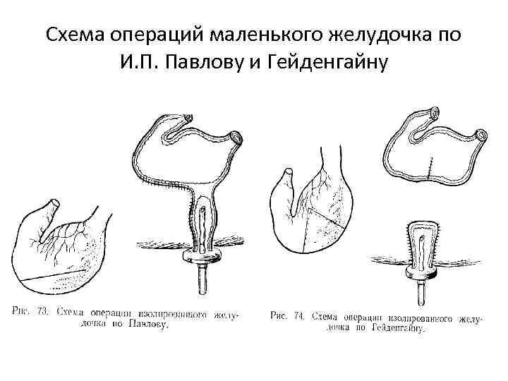 Схема операций маленького желудочка по И. П. Павлову и Гейденгайну 