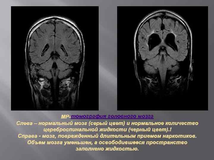 томография головного мозга МР-томография головного мозга Слева – нормальный мозг (серый цвет) и нормальное