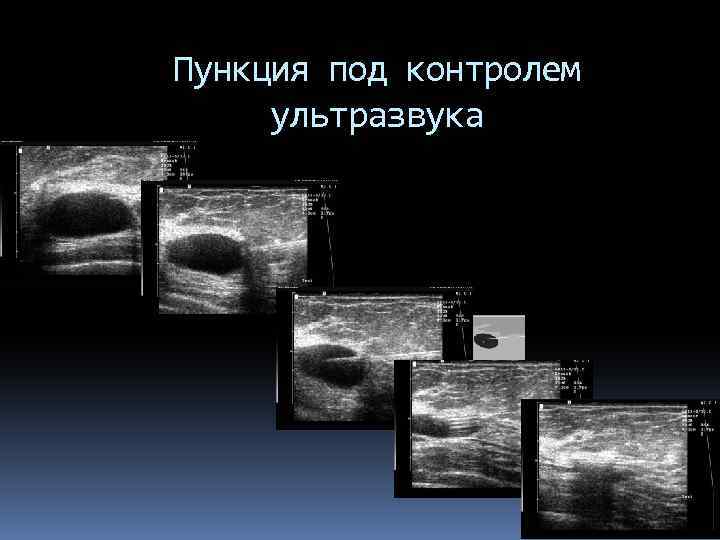 Пункция под контролем ультразвука 