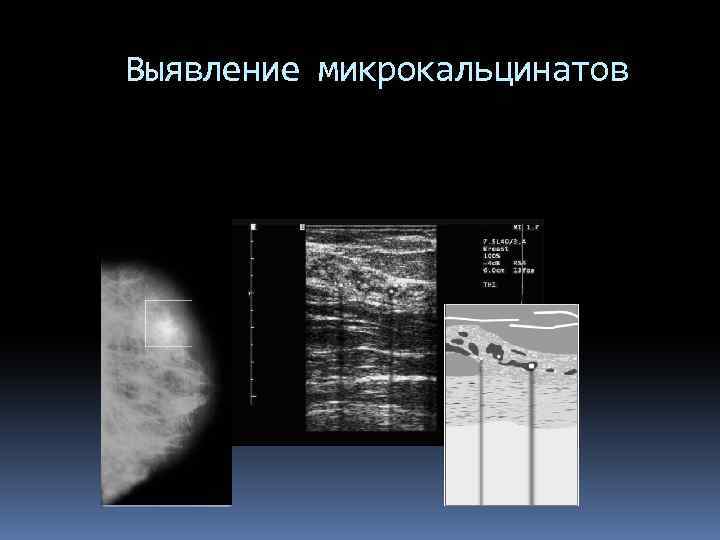 Выявление микрокальцинатов 