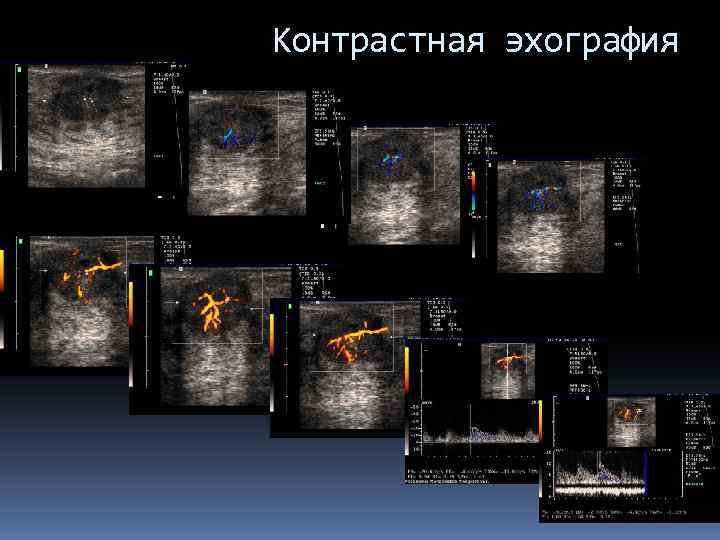 Контрастная эхография 