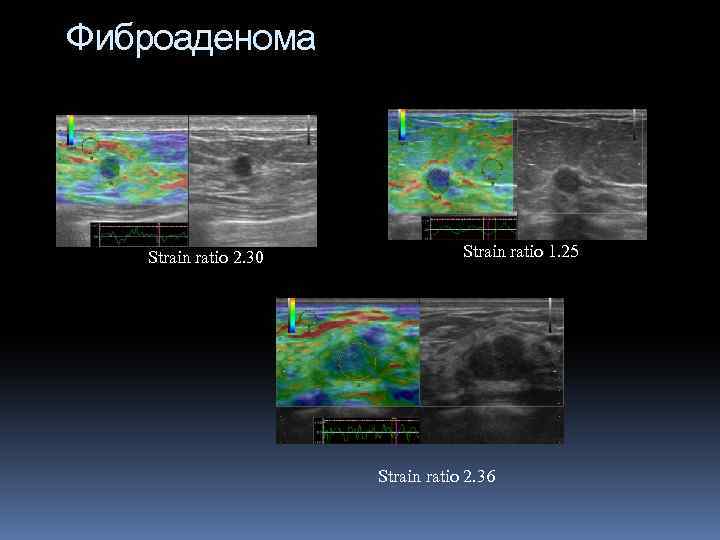 Фиброаденома На соноэластограмме фиброаденома представлена образованием мягкоэластичной консистенции с мозаичным типом картирования с преобладанием