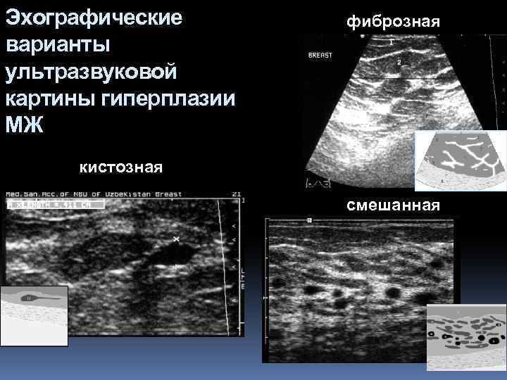 Эхографические варианты ультразвуковой картины гиперплазии МЖ фиброзная кистозная смешанная 