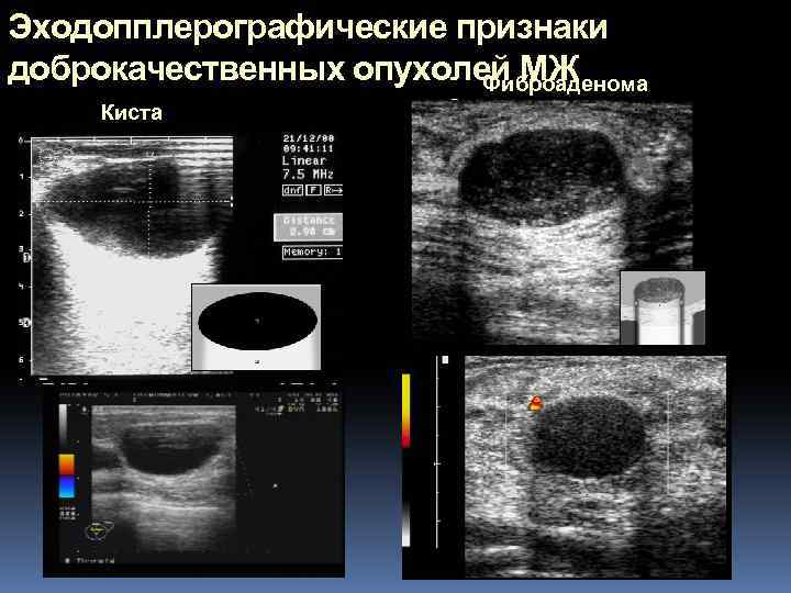 Эходопплерографические признаки доброкачественных опухолей МЖ Фиброаденома Киста 