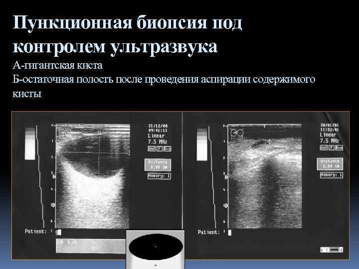 Пункционная биопсия под контролем ультразвука А-гигантская киста Б-остаточная полость после проведения аспирации содержимого кисты