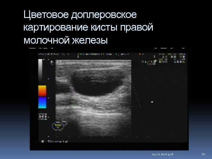 Цветовое доплеровское картирование кисты правой молочной железы 04. 02. 2018 9: 16 70 