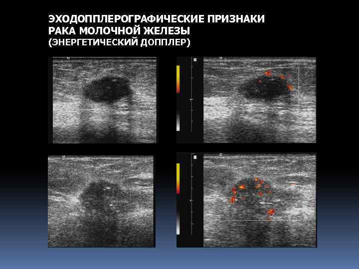 ЭХОДОППЛЕРОГРАФИЧЕСКИЕ ПРИЗНАКИ РАКА МОЛОЧНОЙ ЖЕЛЕЗЫ (ЭНЕРГЕТИЧЕСКИЙ ДОППЛЕР) 