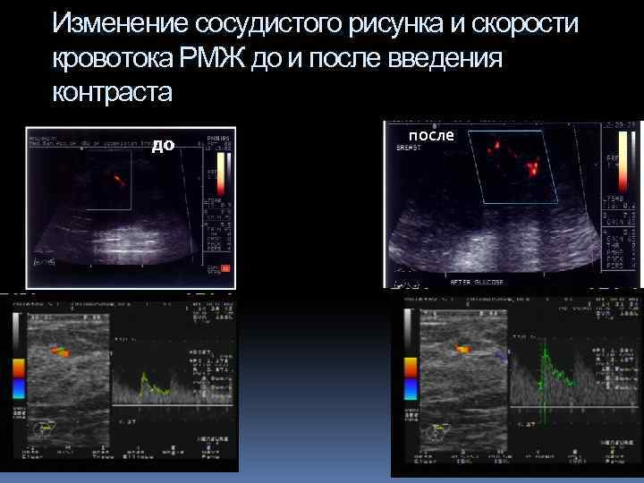 Изменение сосудистого рисунка и скорости кровотока РМЖ до и после введения контраста до после