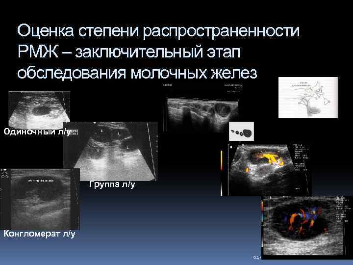 Оценка степени распространенности РМЖ – заключительный этап обследования молочных желез Одиночный л/у Группа л/у