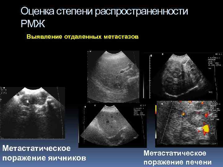 Оценка степени распространенности РМЖ Выявление отдаленных метастазов Метастатическое поражение яичников Метастатическое поражение печени 