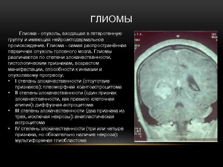 ГЛИОМЫ Глиома - опухоль, входящая в гетерогенную группу и имеющая нейроэктодермальное происхождение. Глиома -