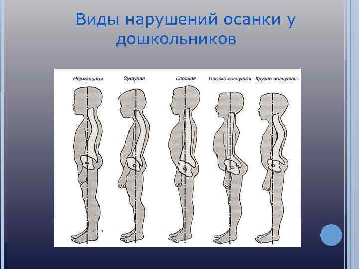 Виды нарушений осанки у дошкольников 