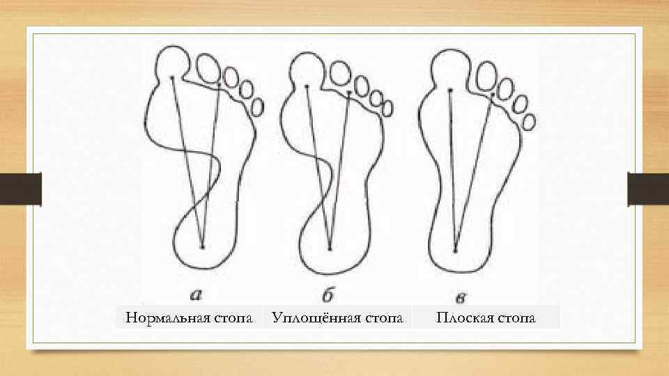 Виды плоскостопия картинки