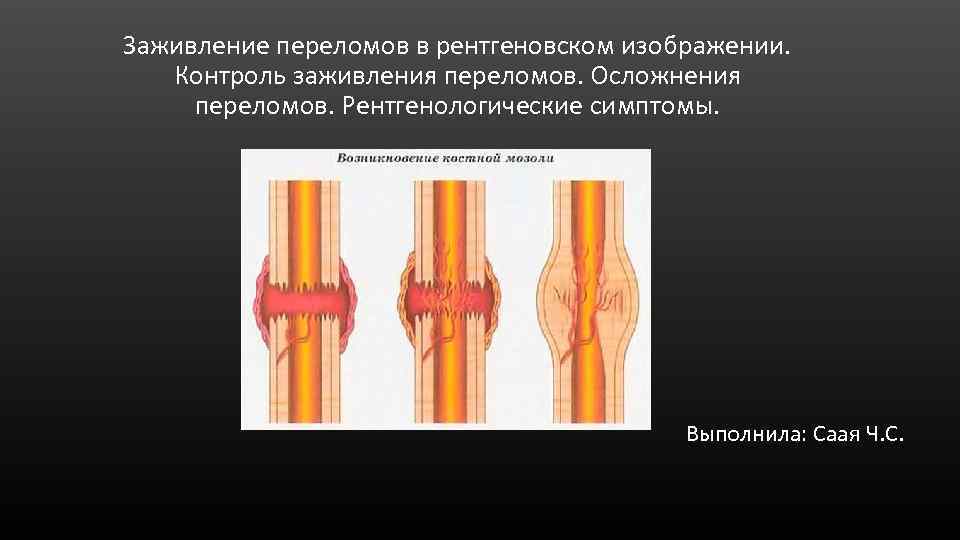 Трещина зажила. Рентгенологические стадии заживления перелома кости. Степень консолидации перелома рентген. Этапы заживления перелома костей. Этапы костной мозоли на рентгене.