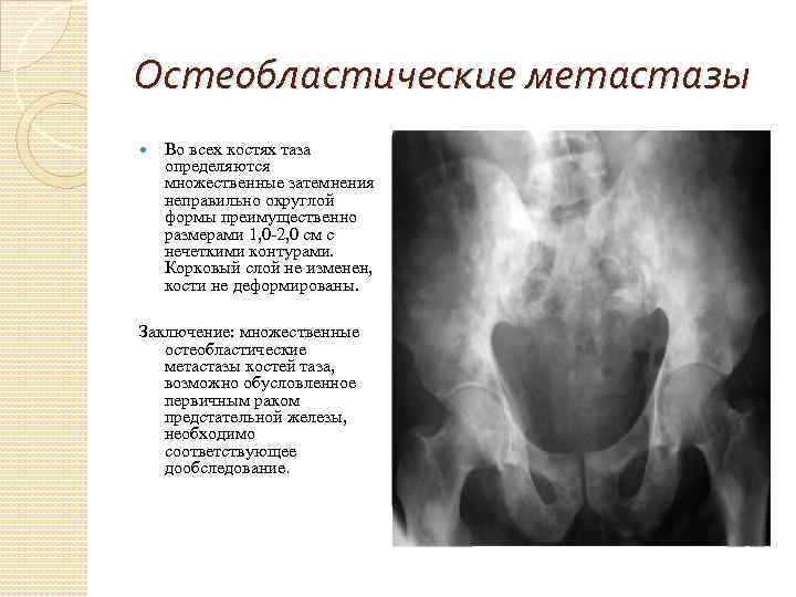 Остеолитический очаг в правой бедренной кости. Остеолитические метастазы рентген. Метастатическое поражение костей таза рентген. Остеобластические метастазы в кости таза на кт.