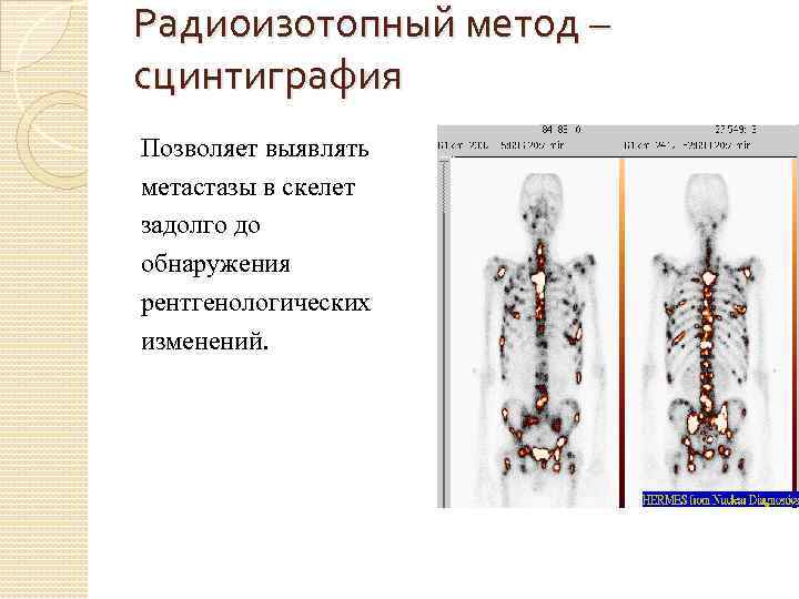 Радиоизотопный метод – сцинтиграфия Позволяет выявлять метастазы в скелет задолго до обнаружения рентгенологических изменений.