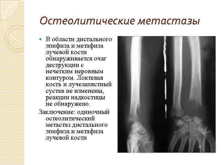 Метастазы костей лечение прогноз