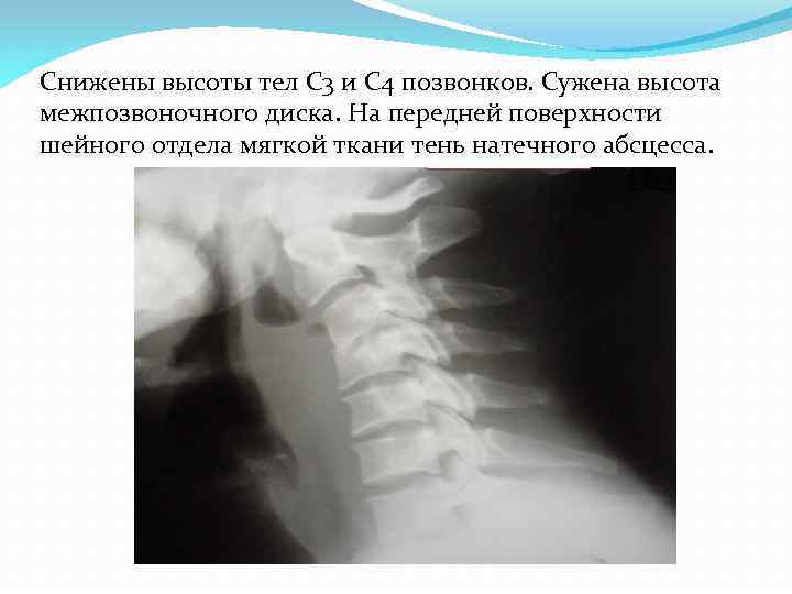 Снижены высоты тел С 3 и С 4 позвонков. Сужена высота межпозвоночного диска. На