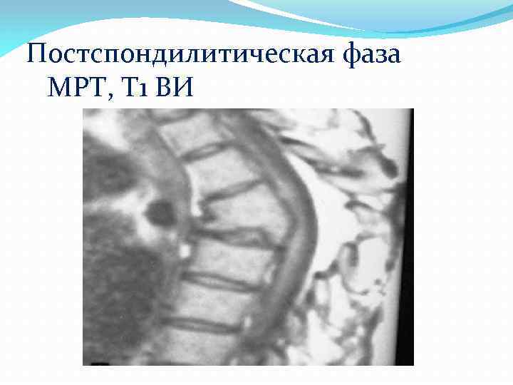 Постспондилитическая фаза МРТ, Т 1 ВИ 