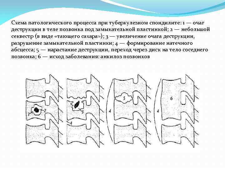 Схема патологического процесса при туберкулезном спондилите: 1 — очаг деструкции в теле позвонка под