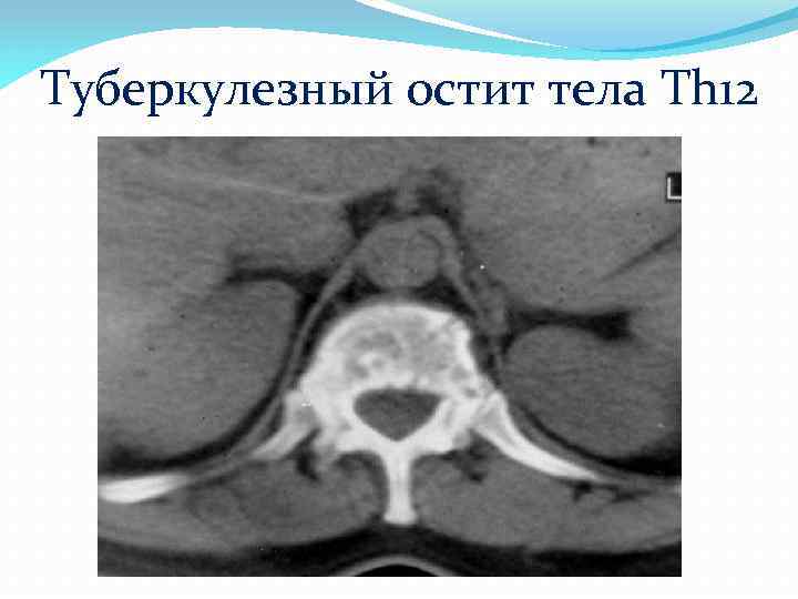 Туберкулезный остит тела Th 12 