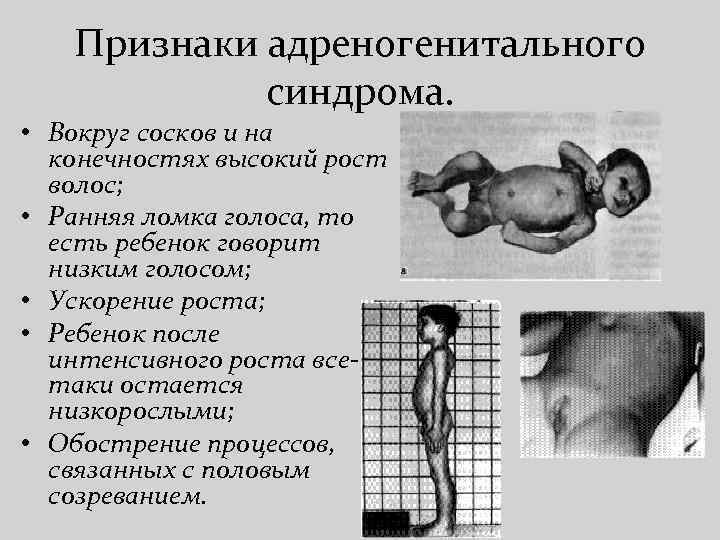 Признаки адреногенитального синдрома. • Вокруг сосков и на конечностях высокий рост волос; • Ранняя