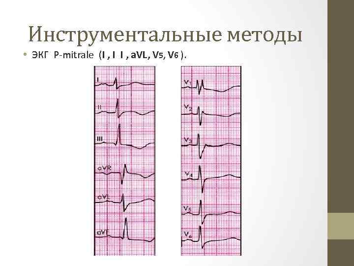 Инструментальные методы • ЭКГ P-mitrale (I , I I , a. VL, V 5,