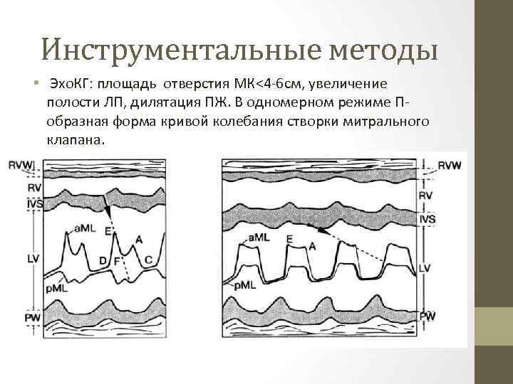 Инструментальные методы • Эхо. КГ: площадь отверстия МК<4 -6 см, увеличение полости ЛП, дилятация