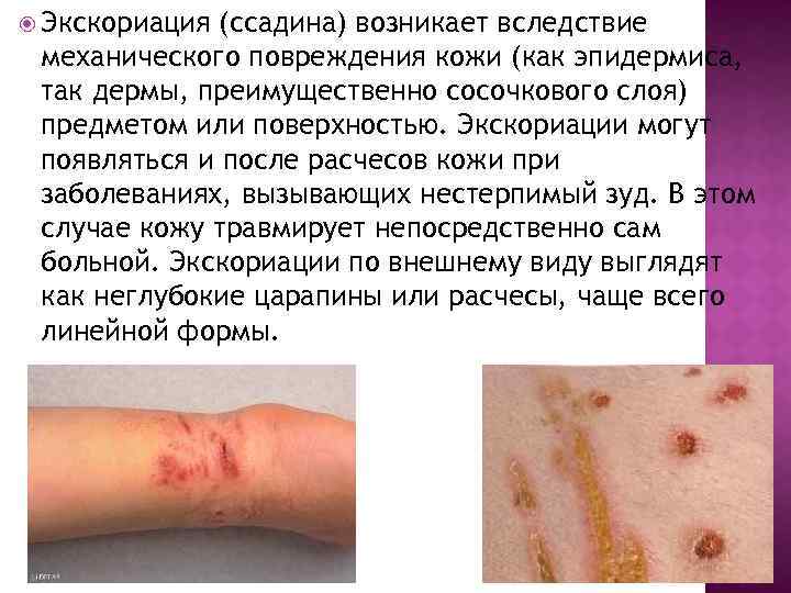  Экскориация (ссадина) возникает вследствие механического повреждения кожи (как эпидермиса, так дермы, преимущественно сосочкового