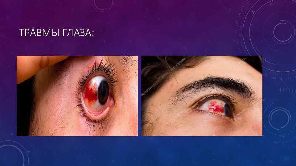ТРАВМЫ ГЛАЗА: 