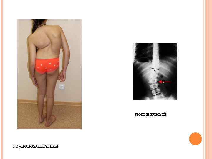 поясничный грудопоясничный 