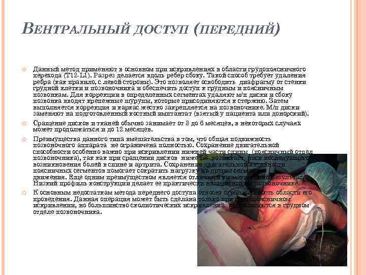 ВЕНТРАЛЬНЫЙ ДОСТУП (ПЕРЕДНИЙ) Данный метод применяют в основном при искривлениях в области грудопоясничного перехода