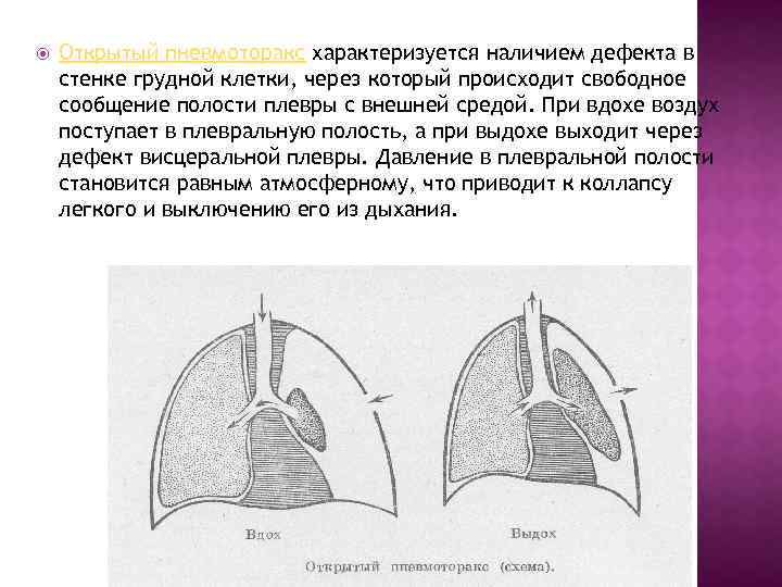  Открытый пневмоторакс характеризуется наличием дефекта в стенке грудной клетки, через который происходит свободное