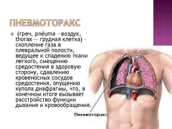  (греч. pnéuma —воздух, thorax — грудная клетка) – скопление газа в плевральной полости,