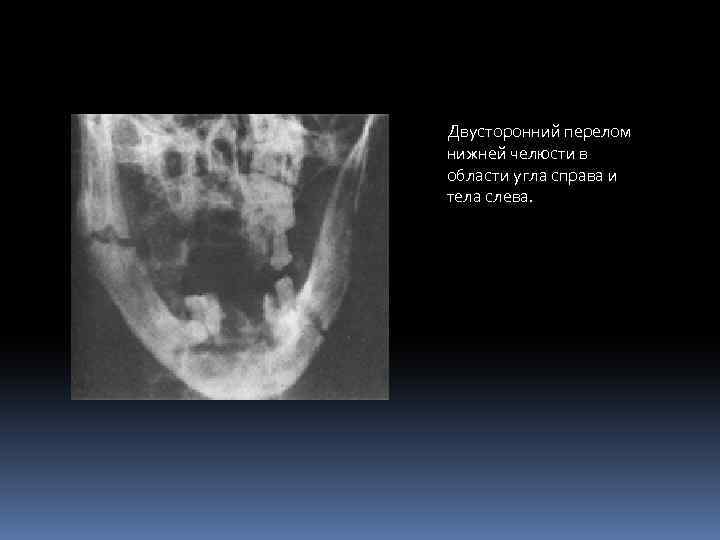 Двусторонний перелом нижней челюсти в области угла справа и тела слева. 
