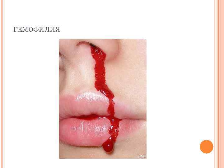 ГЕМОФИЛИЯ 