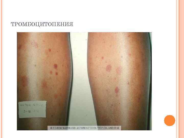 ТРОМБОЦИТОПЕНИЯ 