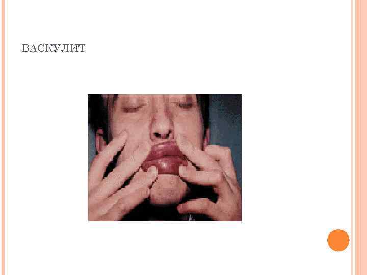 ВАСКУЛИТ 
