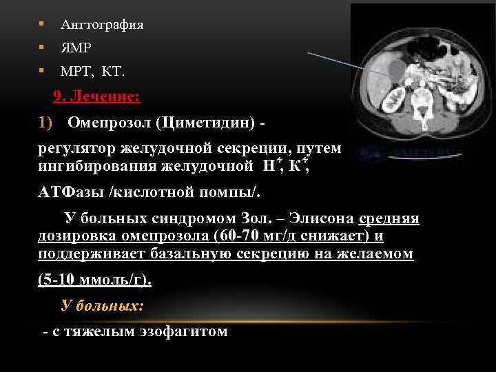 § Ангтография § ЯМР § МРТ, КТ. 9. Лечение: 1) Омепрозол (Циметидин) регулятор желудочной