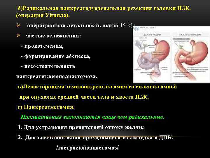 б)Радикальная панкреатодуоденальная резекция головки П. Ж. (операция Уйппла). Ø операционная летальность около 15 %;