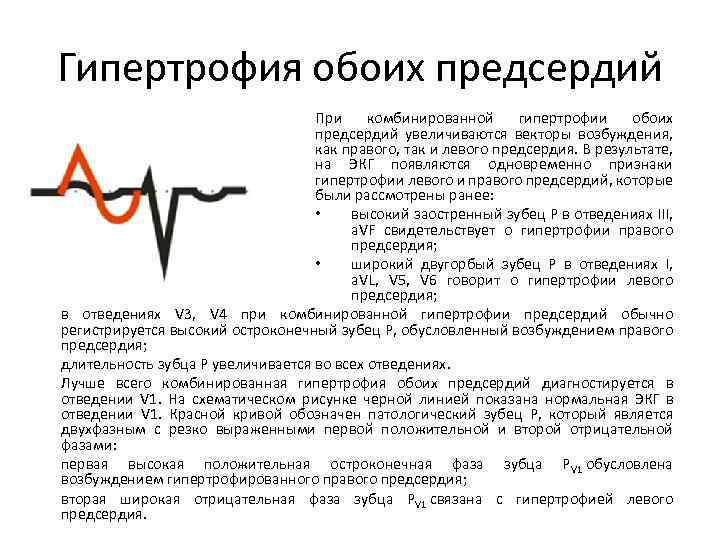 Гипертрофия обоих предсердий При комбинированной гипертрофии обоих предсердий увеличиваются векторы возбуждения, как правого, так